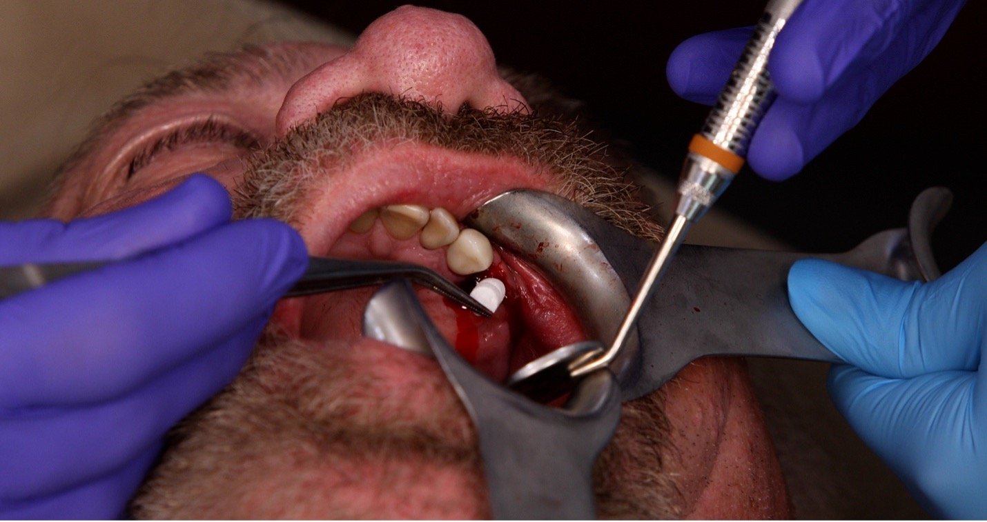 OsteoGen® Plug Clinical Guide